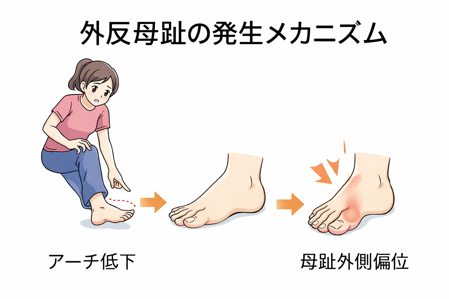 外反母趾に対する運動療法の効果