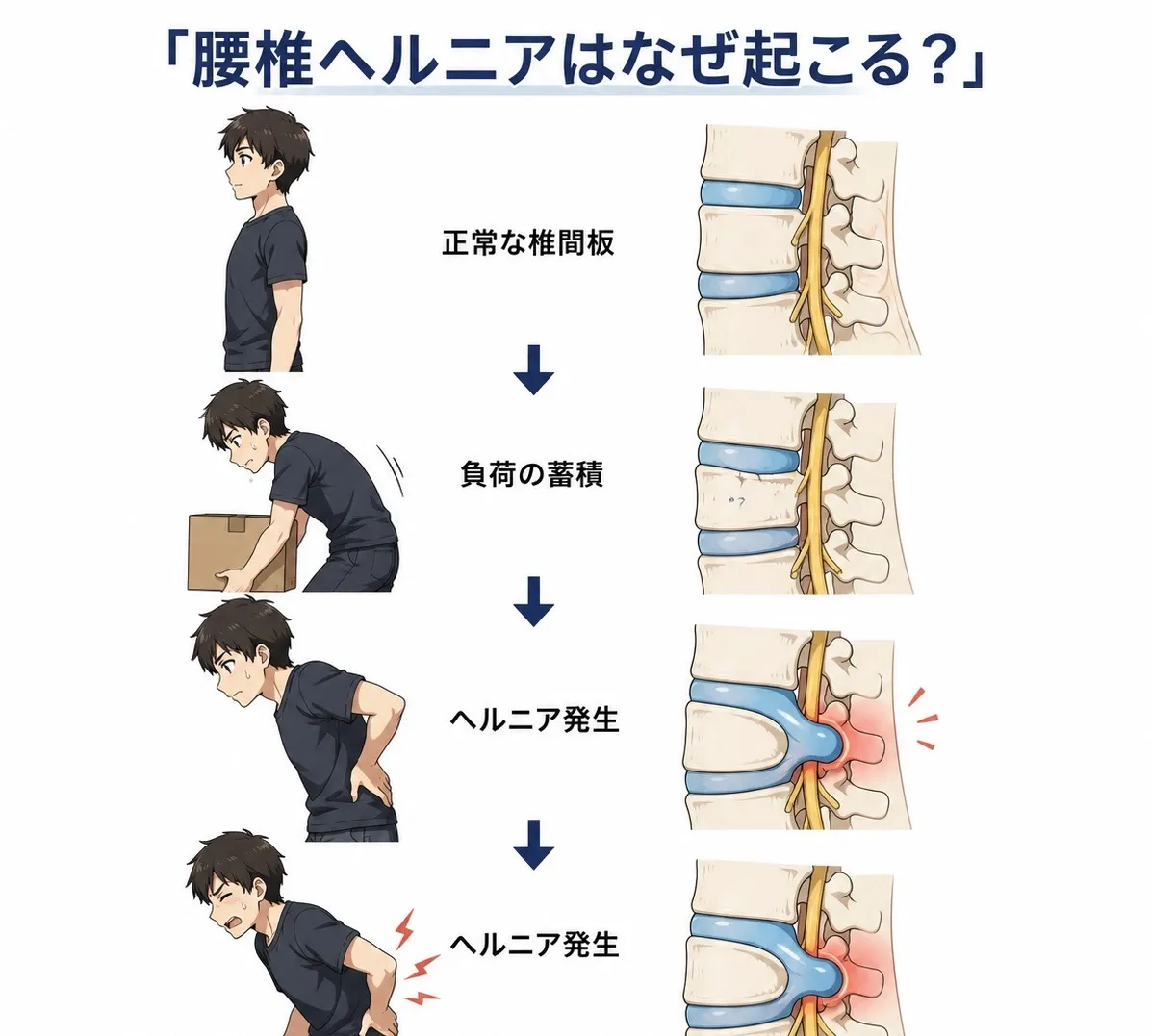 腰椎ヘルニア予防のための筋トレ
